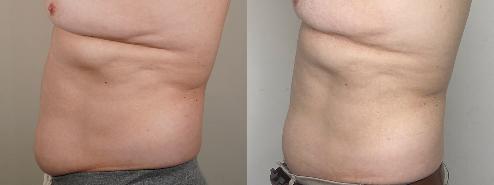 BodyTite Before & After Image