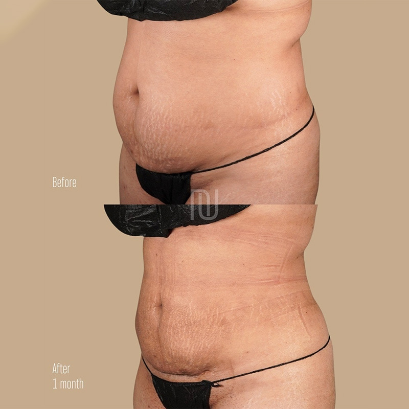 BodyTite Before & After Image