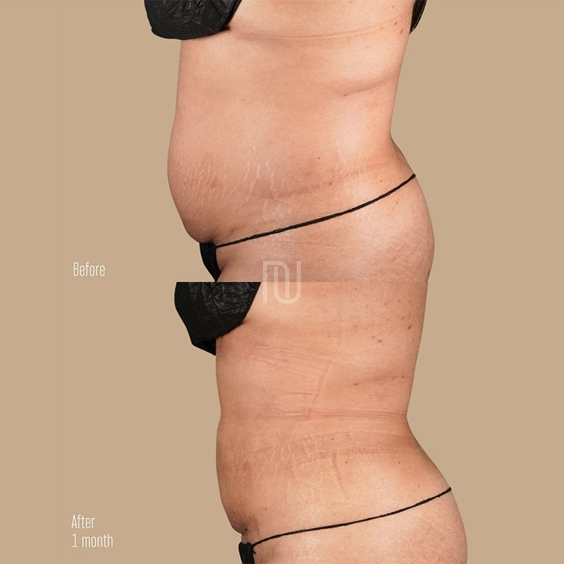 BodyTite Before & After Image