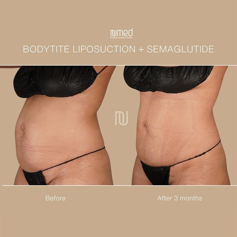 BodyTite Before & After Image