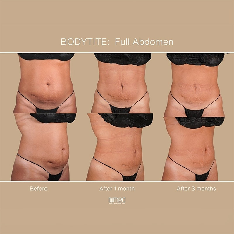 BodyTite Before & After Image