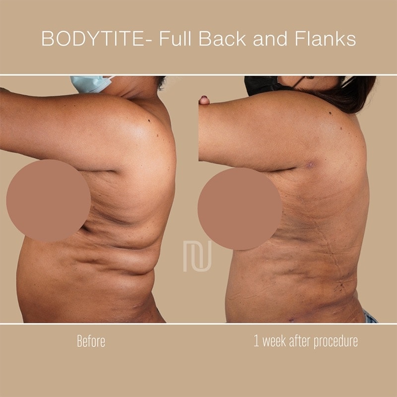 BodyTite Before & After Image