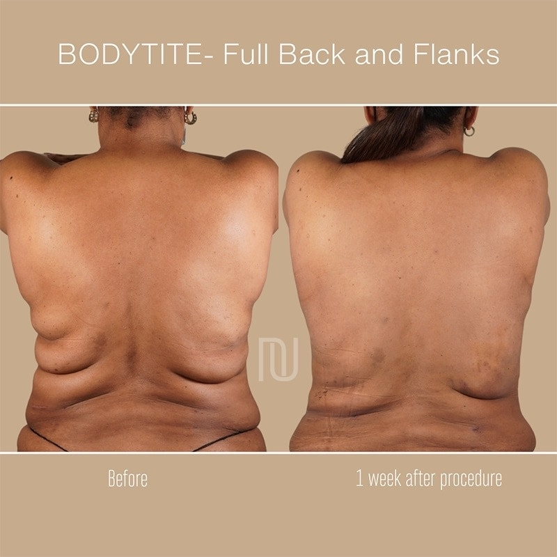 BodyTite Before & After Image