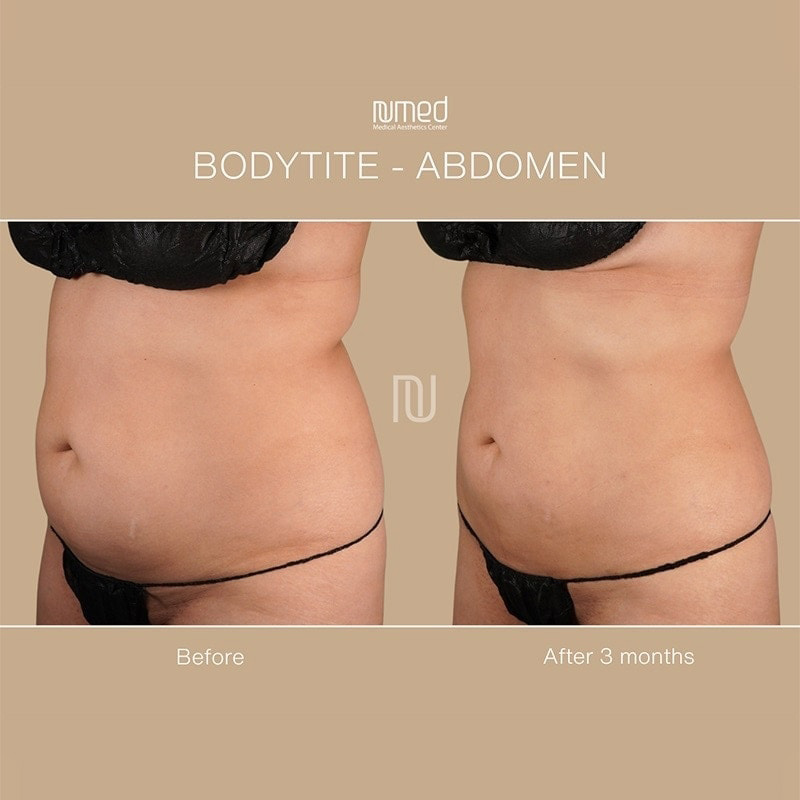 BodyTite Before & After Image