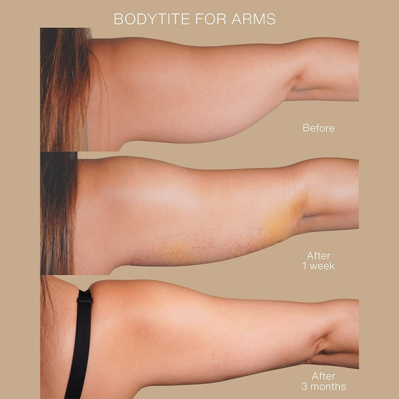 BodyTite Before & After Image