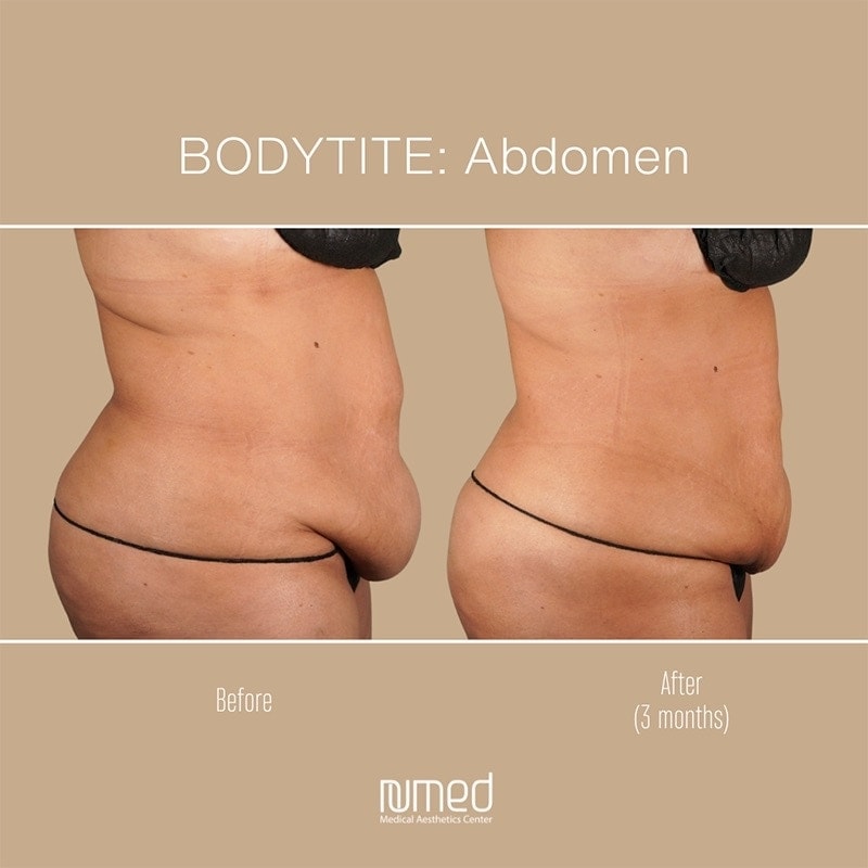 BodyTite Before & After Image