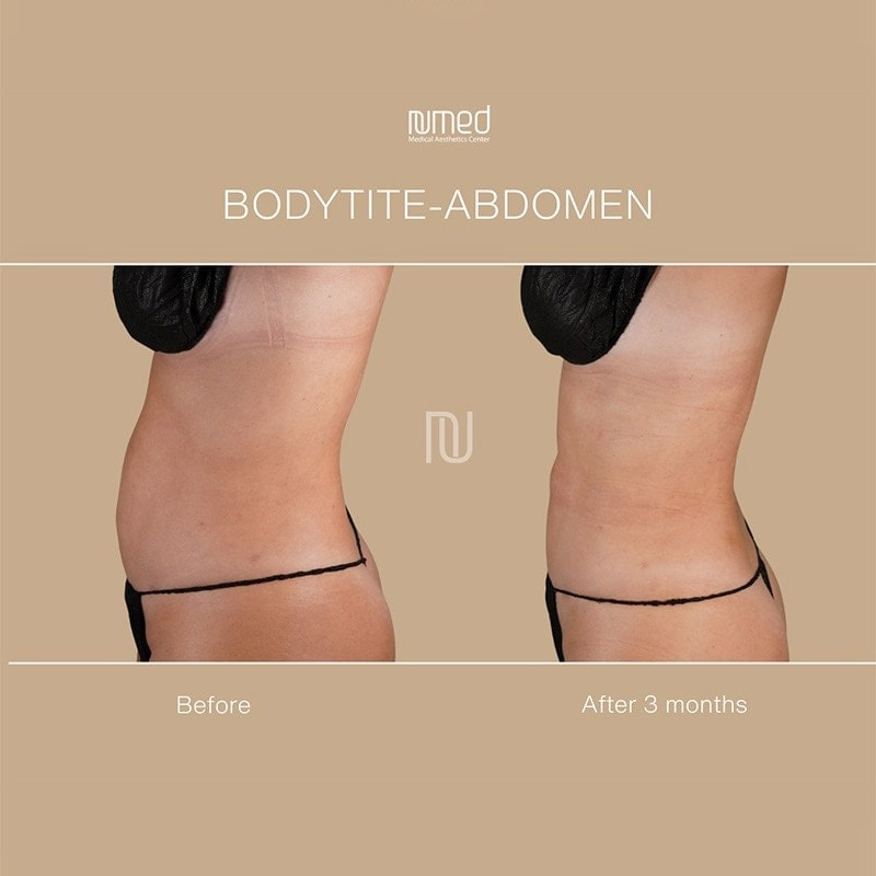 BodyTite Before & After Image