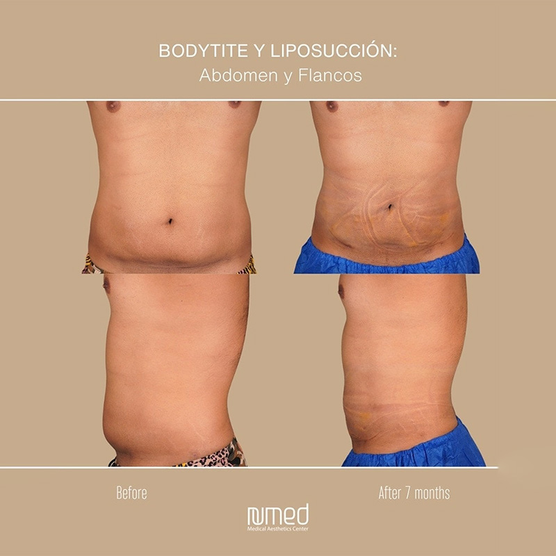 BodyTite Before & After Image