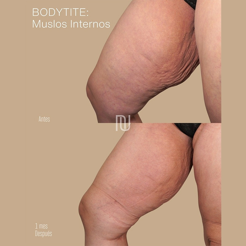 BodyTite Before & After Image