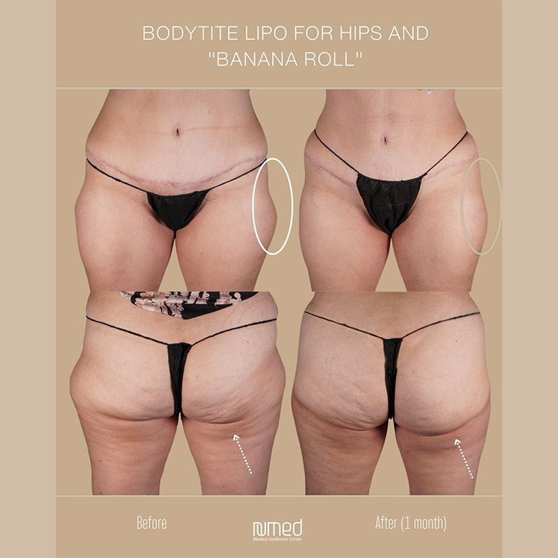 BodyTite Before & After Image