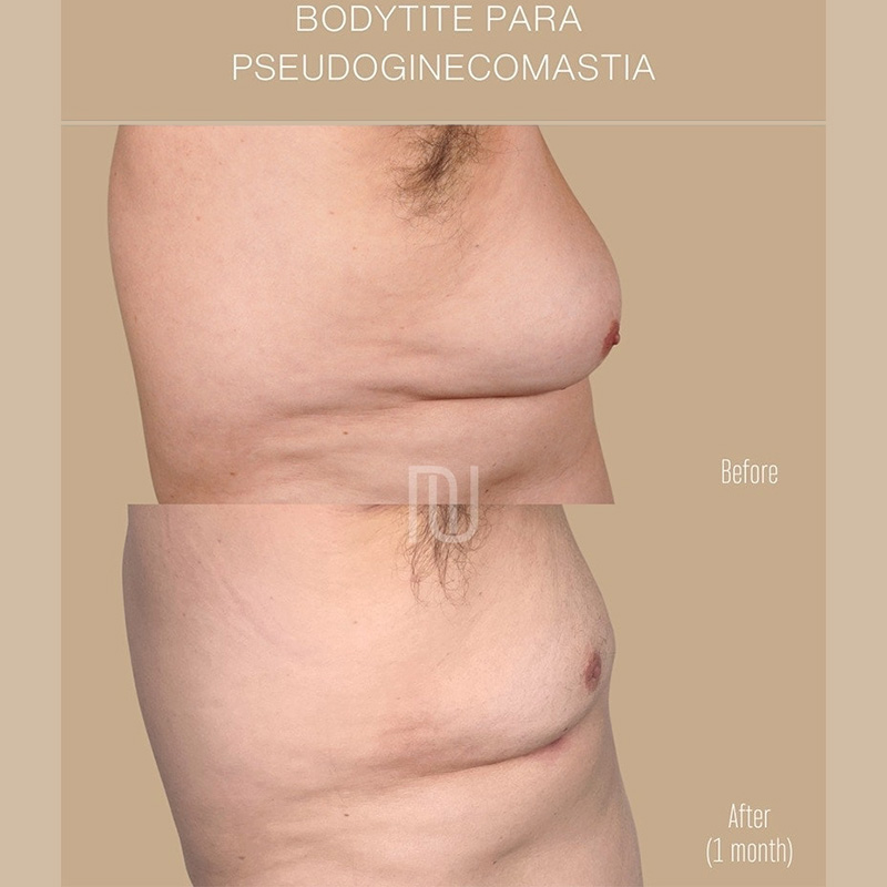 BodyTite Before & After Image