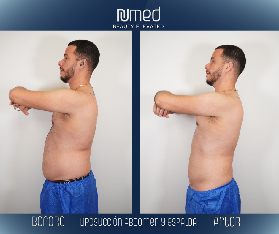 BodyTite Before & After Image