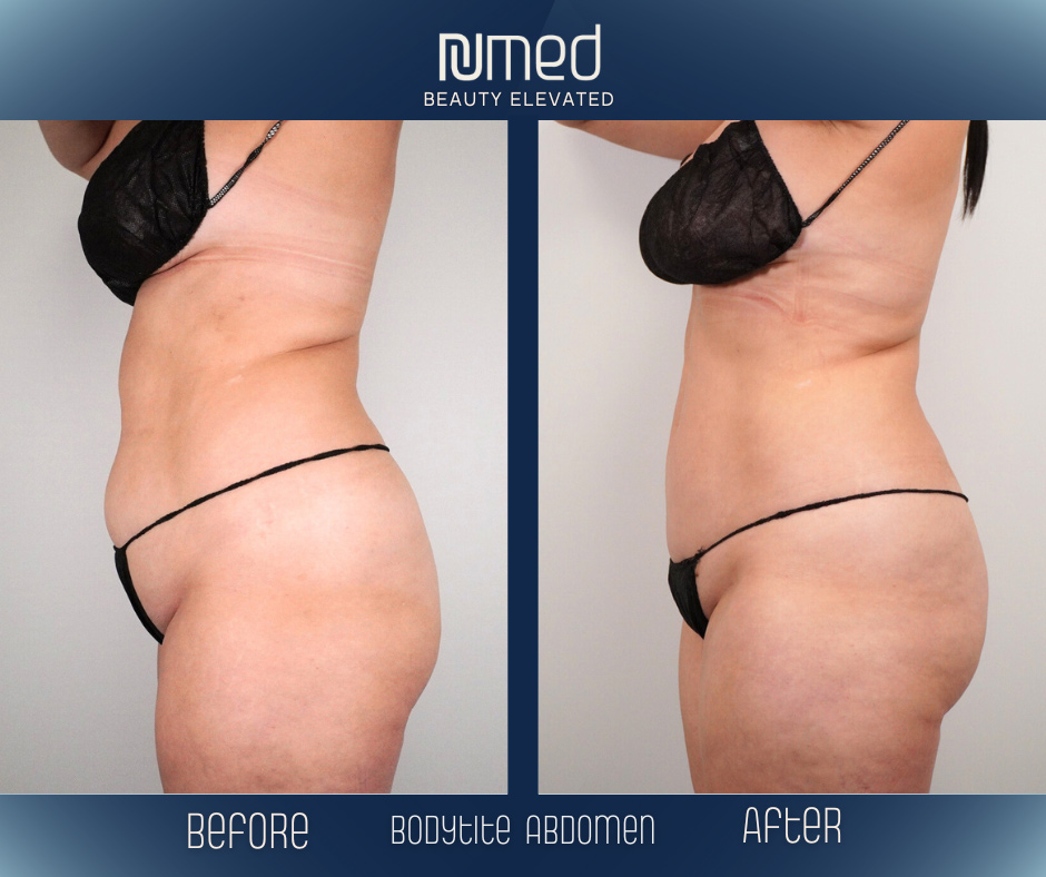 BodyTite Before & After Image