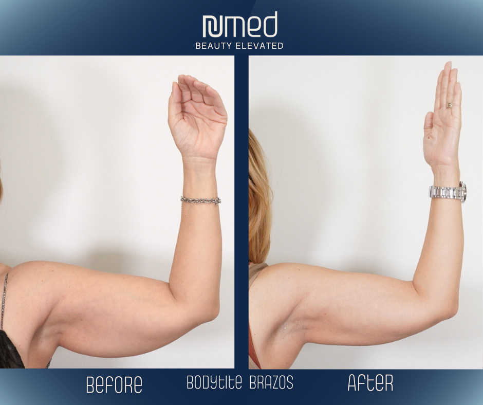 BodyTite Before & After Image