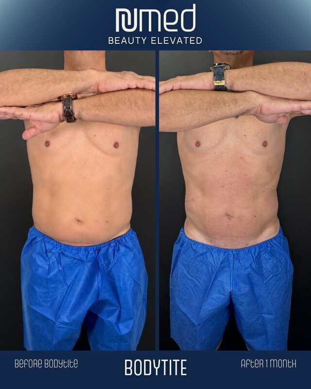 BodyTite Before & After Image