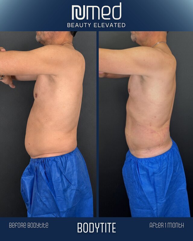 BodyTite Before & After Image