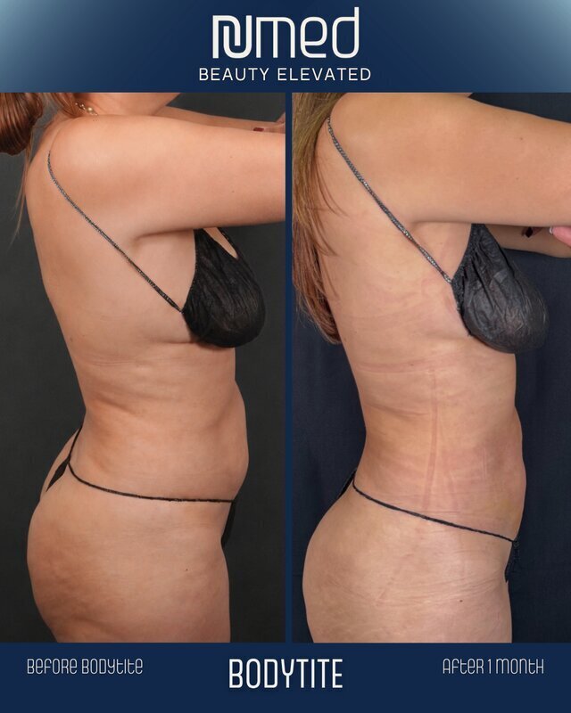 BodyTite Before & After Image