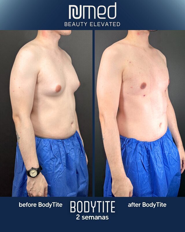 BodyTite Before & After Image