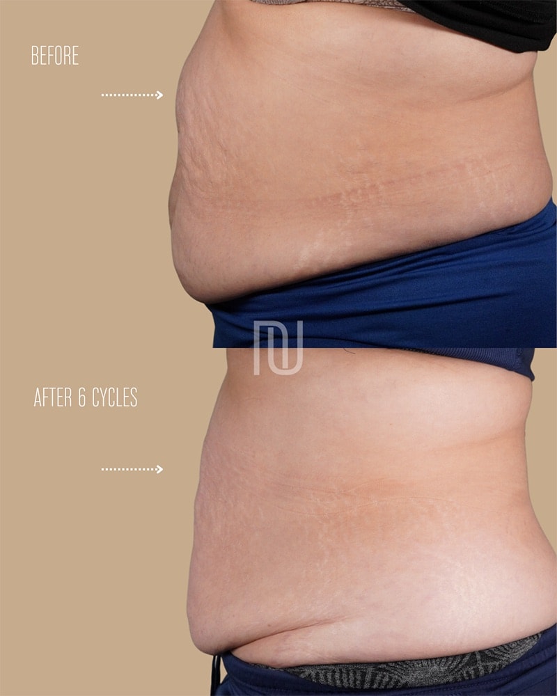 Coolsculpting Before & After Image