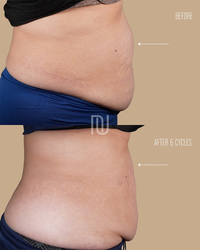 Coolsculpting Before & After Image