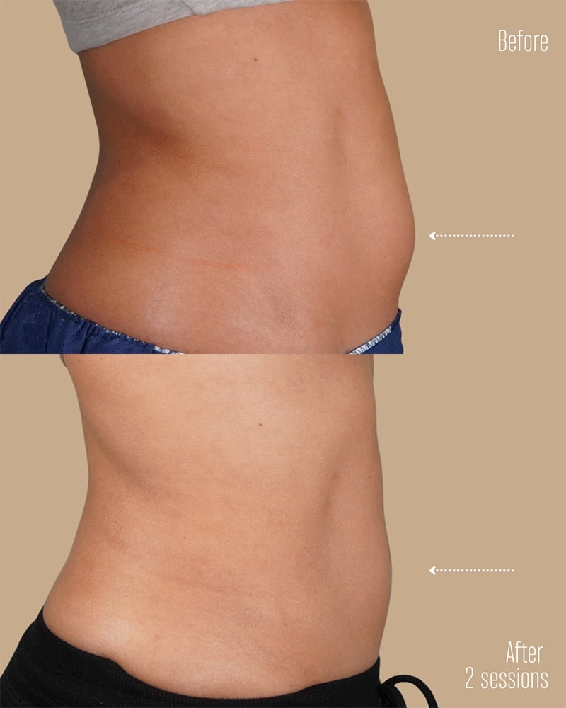 Coolsculpting Before & After Image