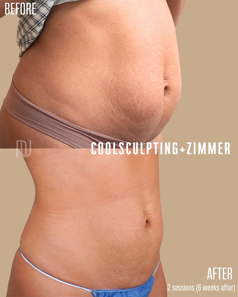 Coolsculpting Before & After Image