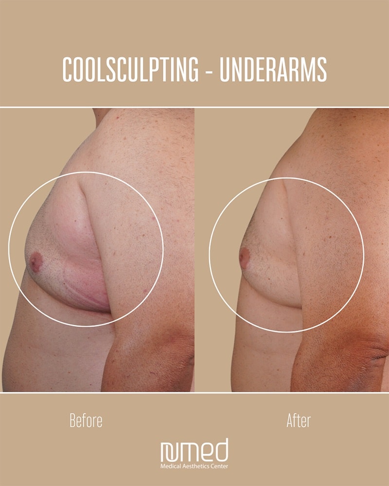 Coolsculpting Before & After Image