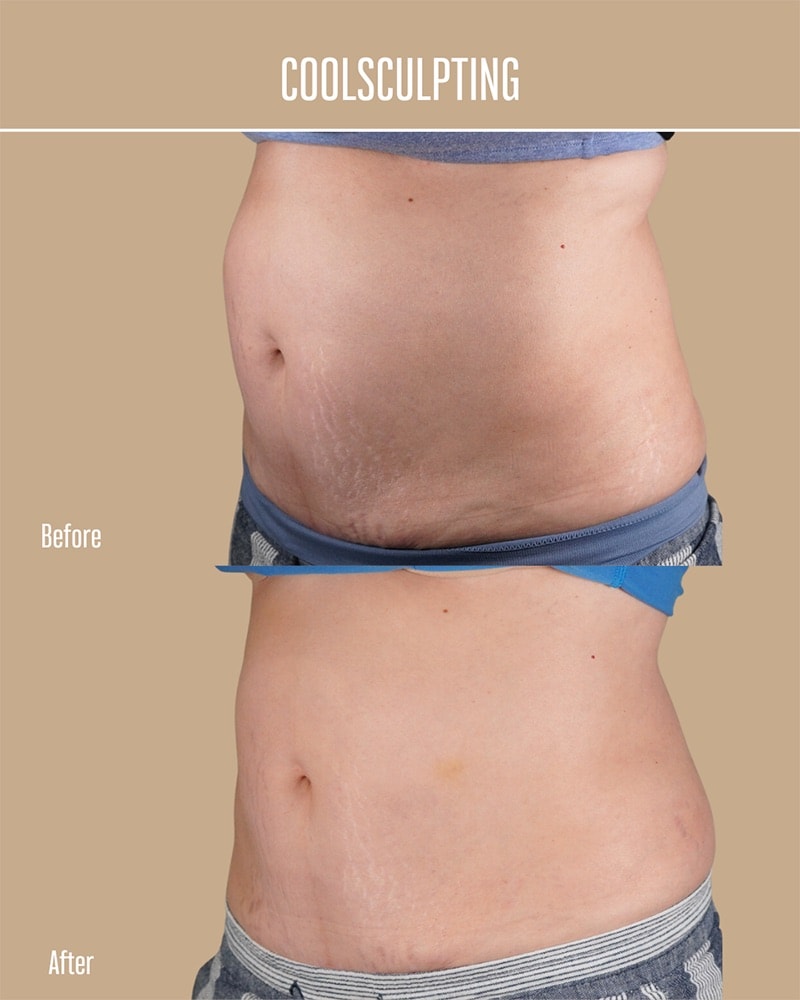 Coolsculpting Before & After Image