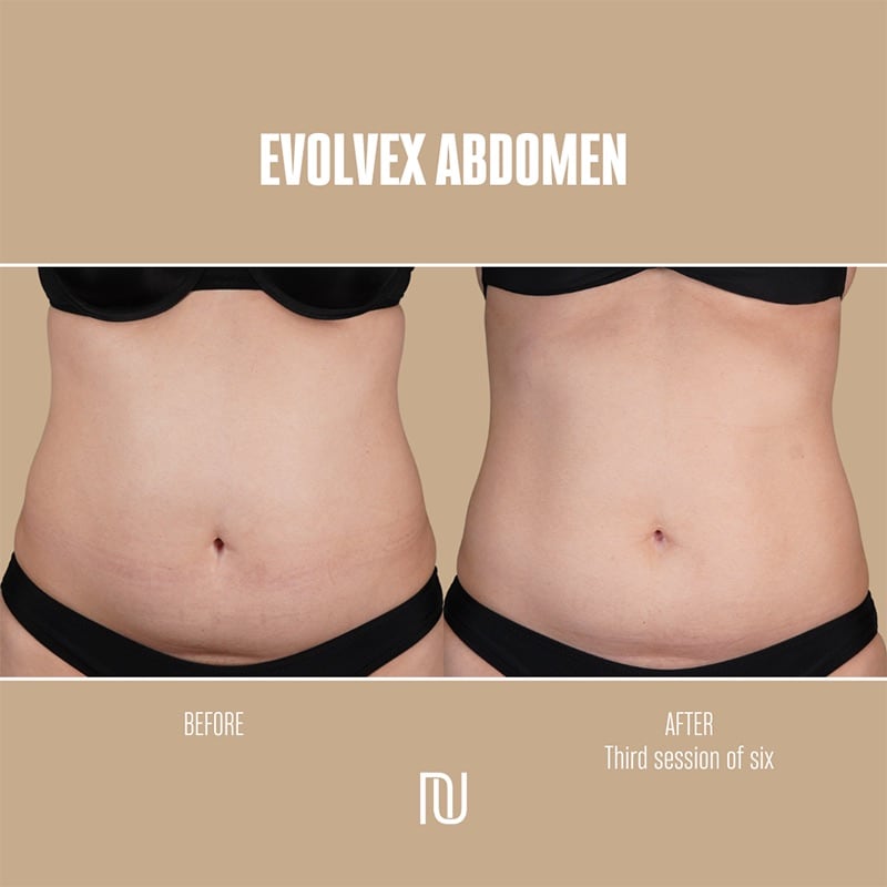 EvolveX Before & After Image