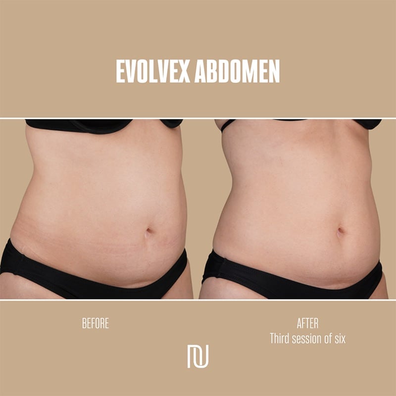 EvolveX Before & After Image