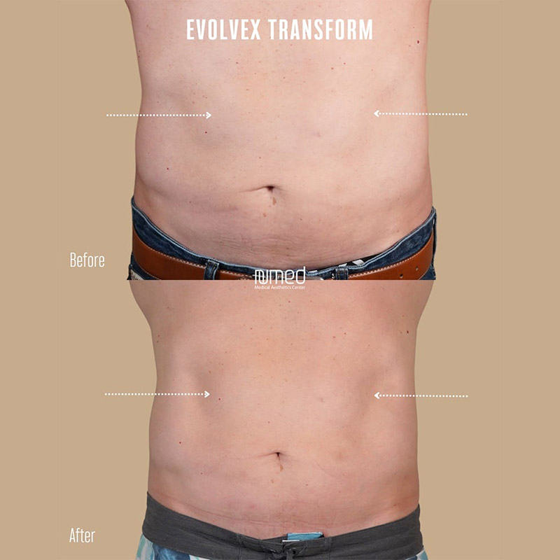 EvolveX Before & After Image