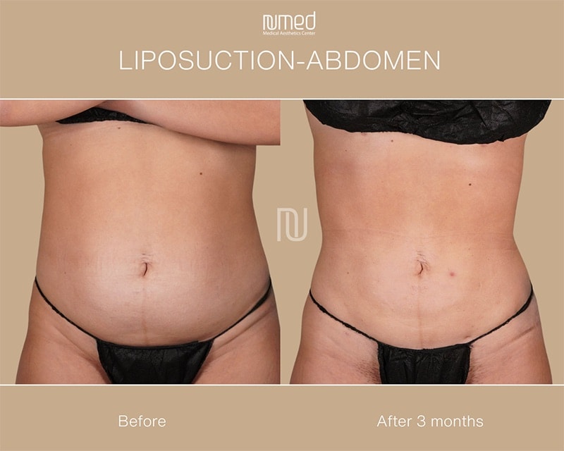 Liposuction Before & After Image