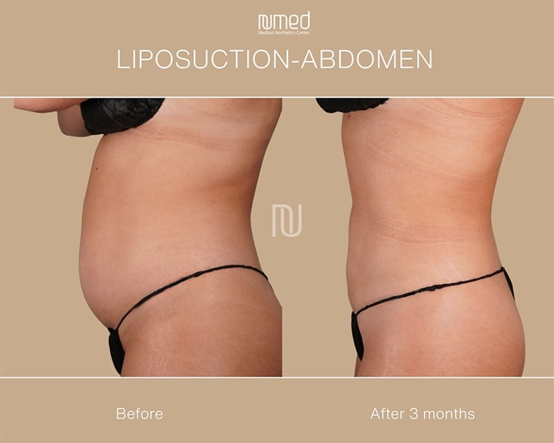 Liposuction Before & After Image