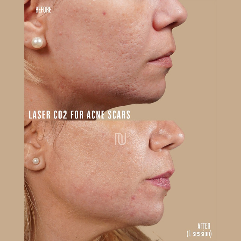 Acne & Scar Treatment Before & After Image