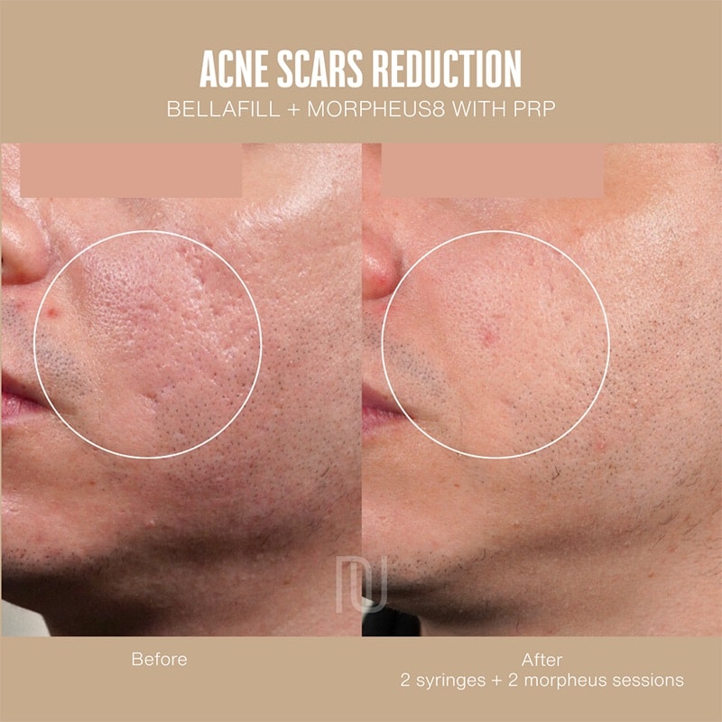 Acne & Scar Treatment Before & After Image