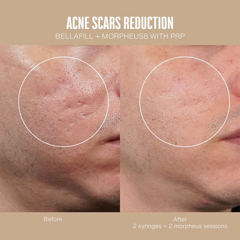 Acne & Scar Treatment Before & After Image