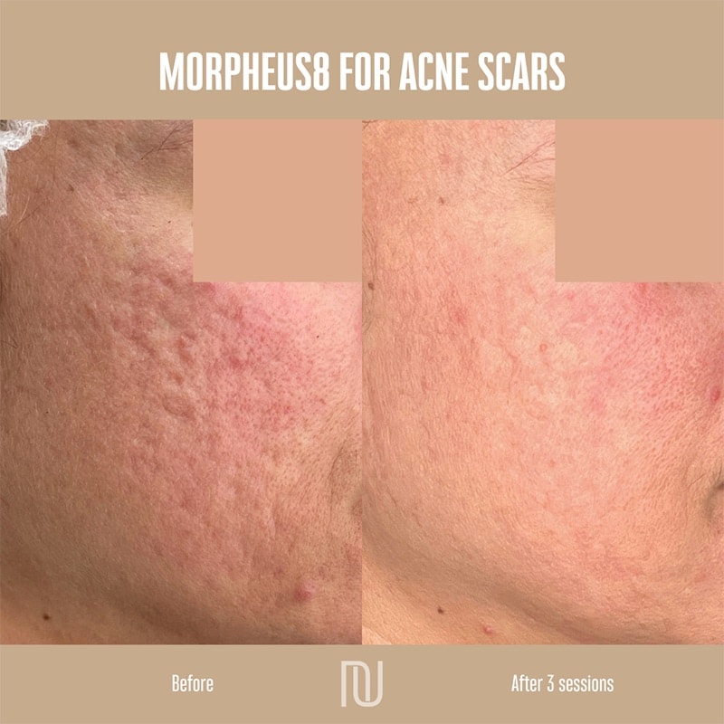 Acne & Scar Treatment Before & After Image