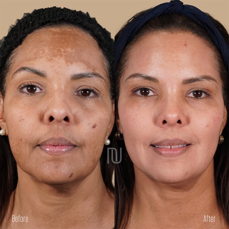 Chemical Peel Before & After Image