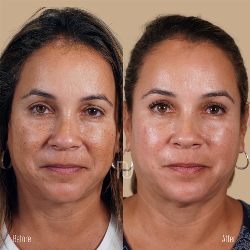 Chemical Peel Before & After Image