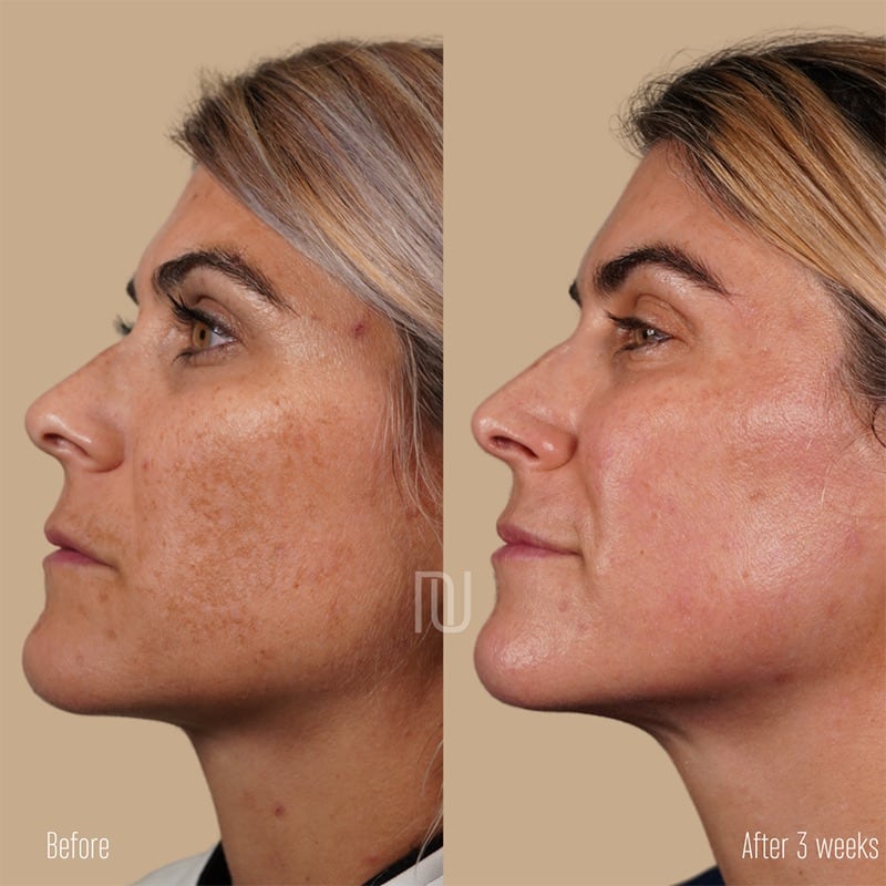 Chemical Peel Before & After Image