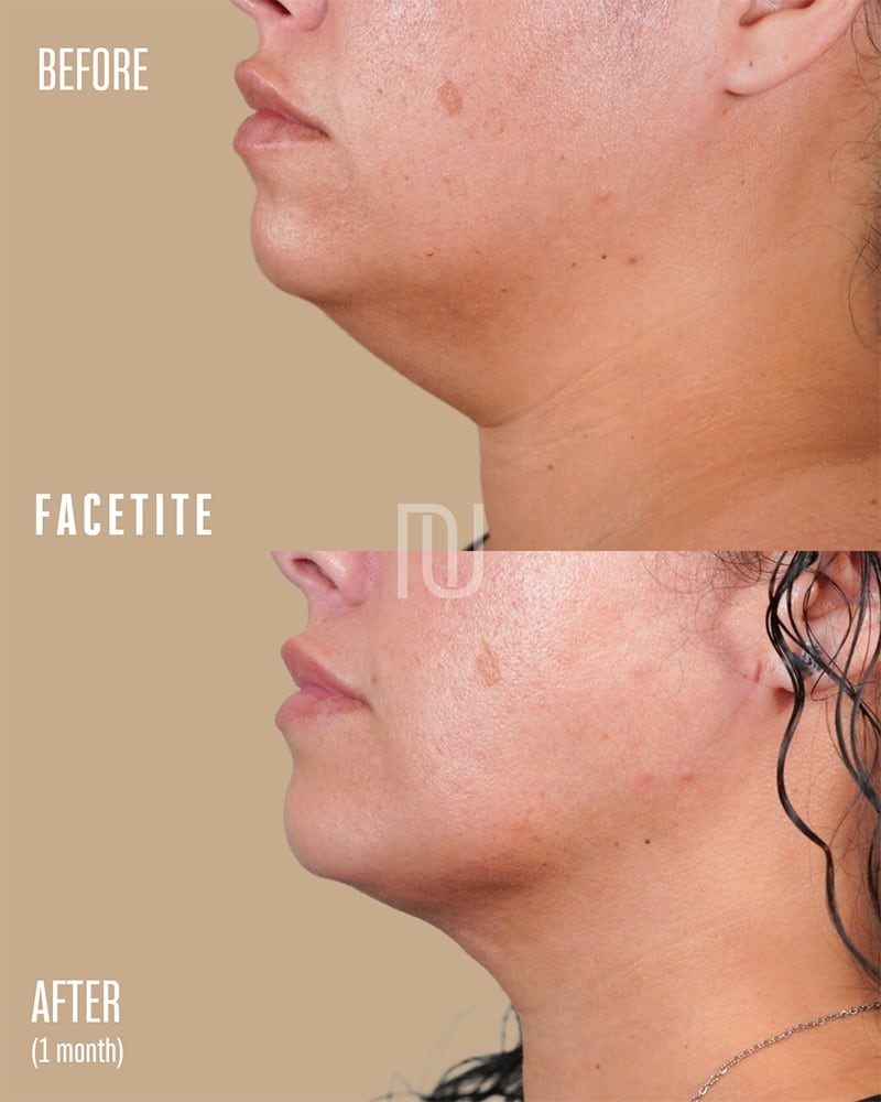 FaceTite Before & After Image