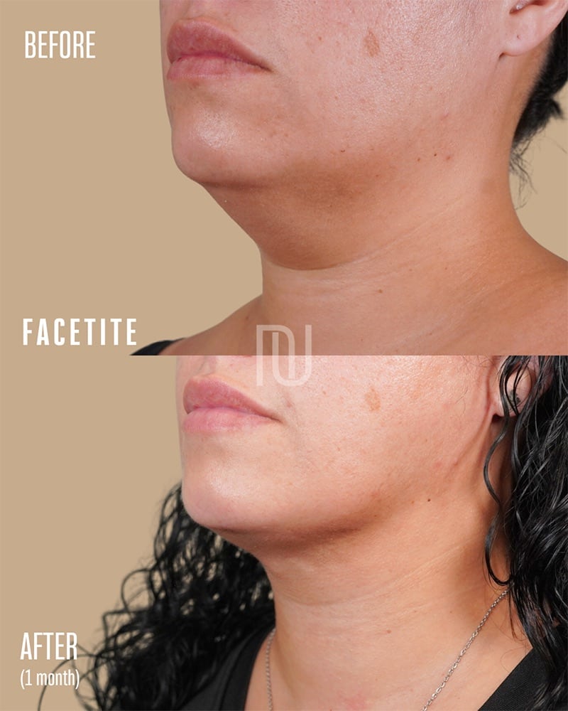 FaceTite Before & After Image