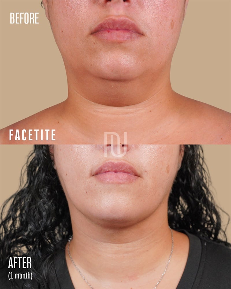 FaceTite Before & After Image