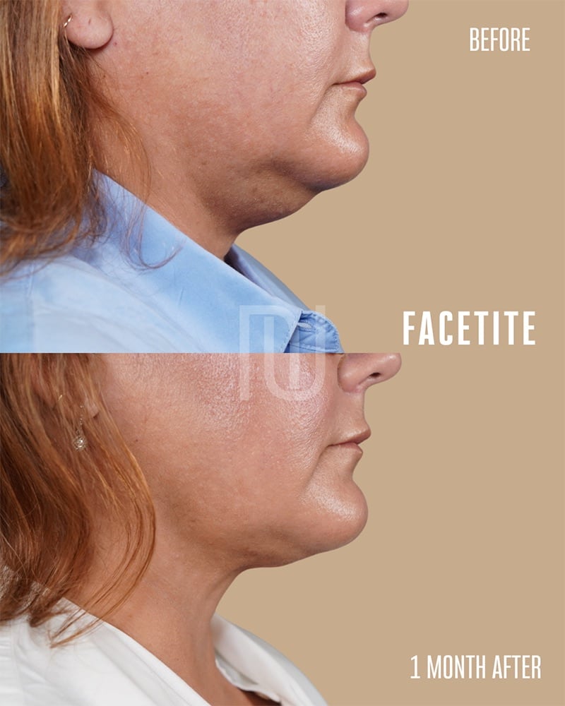 FaceTite Before & After Image