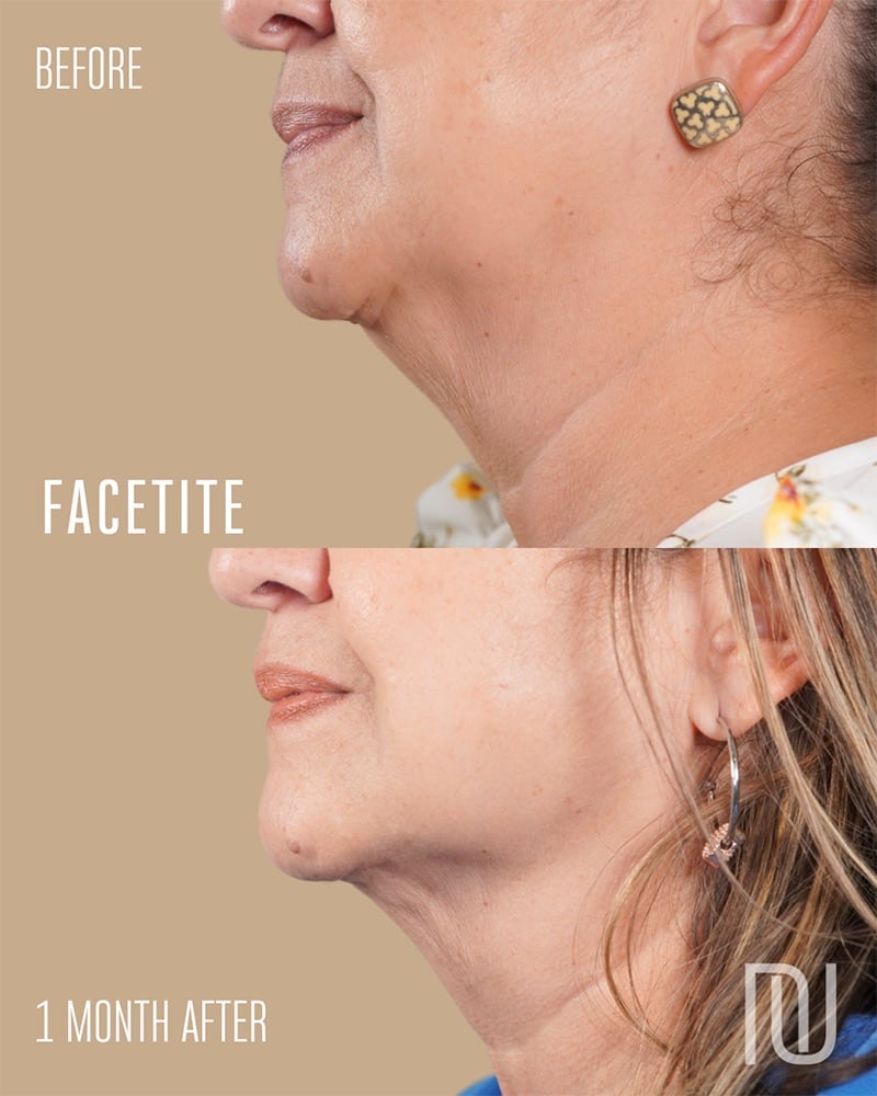 FaceTite Before & After Image