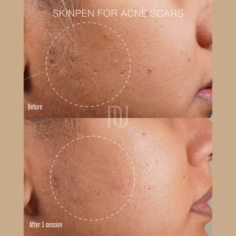 SkinPen Before & After Image