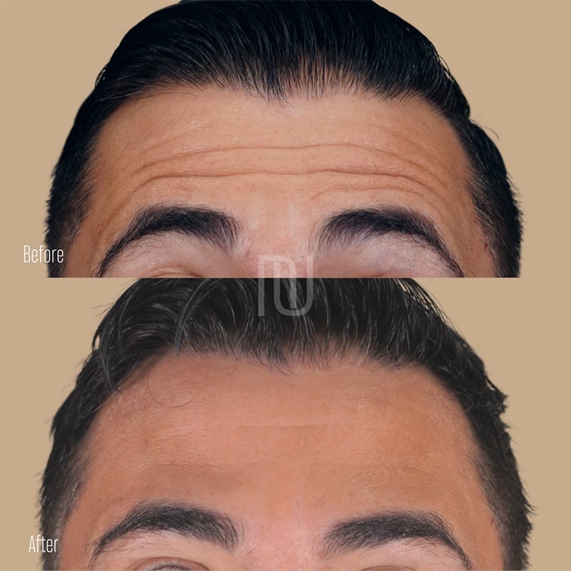 Botox Before & After Image