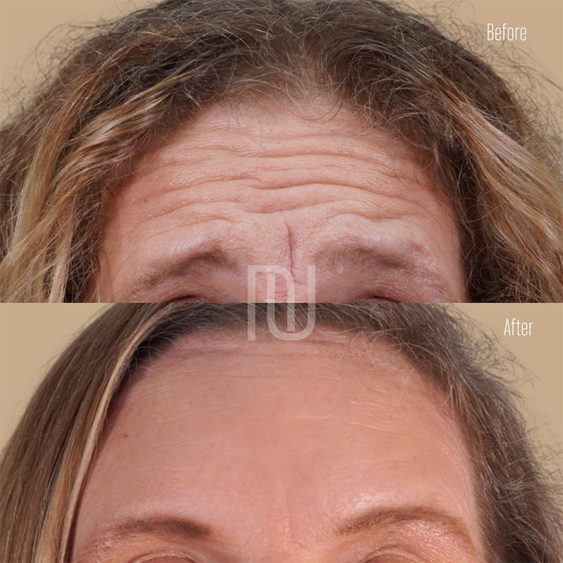 Botox Before & After Image