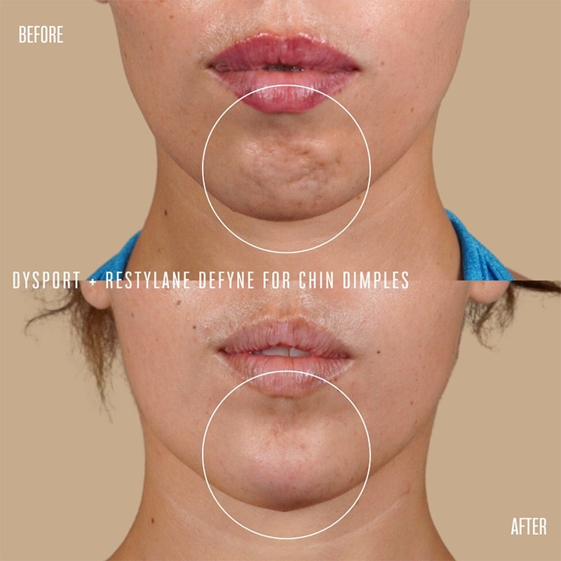 Dermal Fillers Before & After Image