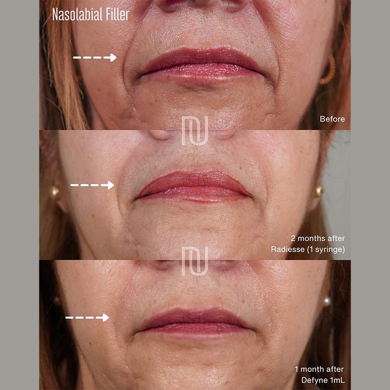 Dermal Fillers Before & After Image